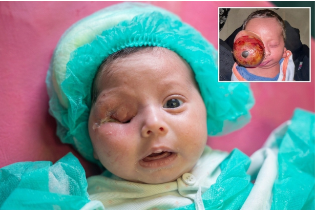 Pakistan reports first documented 285-gram congenital eye tumor in newborn 2 Pakistan reports first documented 285-gram congenital eye tumor in newborn